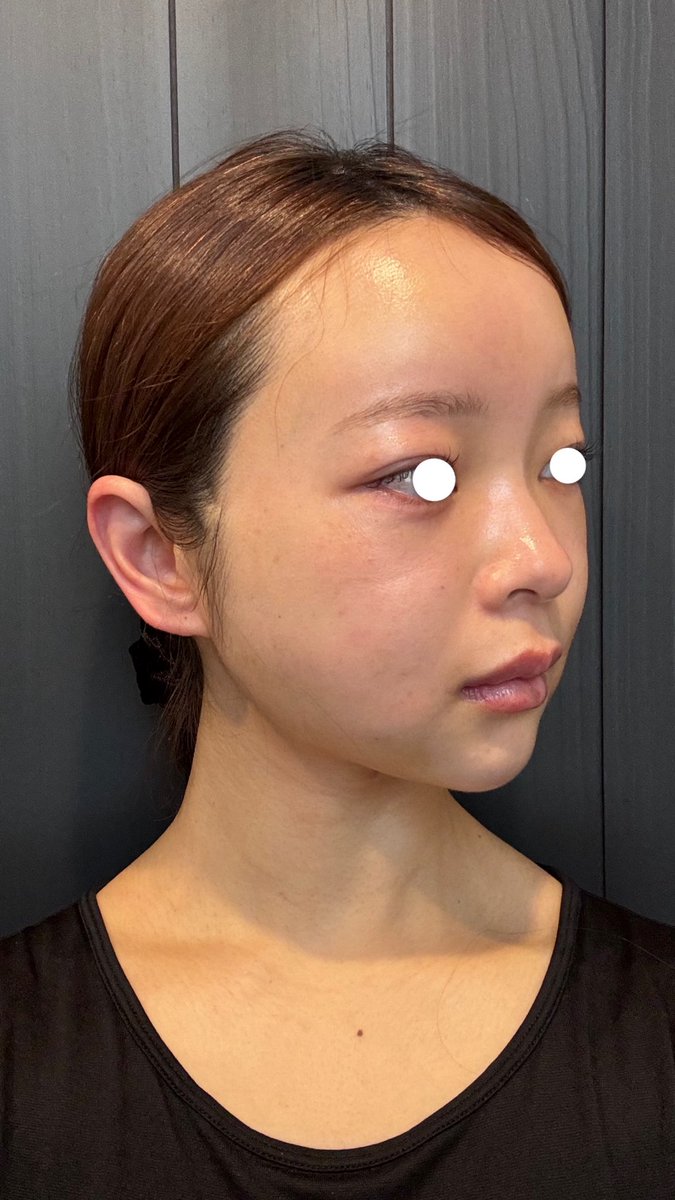 __04221205's tweet photo. トップフェイスさん🏥@topfacejp

・フェイスラインの脂肪吸引
・フルフェイス脂肪移植
・糸リフト6本 
・目の下脂肪再配置 

11/7に手術→3週間経過
気になってたほうれい線やゴルゴラインは目立ちづらくなったかも？？

肌加工も無しのリアルなアザです
まだ腫れは残ってます���あと少しの辛抱 https://t.co/ImJqfa55mA
