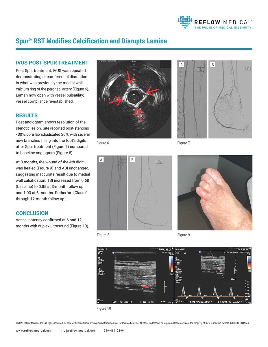 reflowmedical's tweet photo. Heavy medial calcification and significant soft plaque made this CLTI case challenging and typical of real-world BTK disease.

This new case report shows how the Spur® Stent System achieved IVUS-confirmed disruption of medial calcification and supported complete wound healing in a peroneal artery lesion treated by @FadiSaab17 Fadi Saab, MD, FACC, FSCAI, FASE.

A 51-year-old male (Rutherford Class 5) with Type I diabetes and a prior kidney transplant presented with minor tissue loss of the 4th digit and a 50 mm peroneal artery lesion with heavy medial calcification, soft plaque, and 76% stenosis. After predilatation, a 3.0 × 65 mm Spur Stent was used.

IVUS post-treatment demonstrated disruption of the medial calcium ring with restored vessel pulsatility and compliance.

Outcomes:
• Complete wound healing at 3 months
• Rutherford Class 0 through 12 months
• Patency at 6 and 12 months (duplex)

📄 Read the full case report below or on our website:
https://t.co/XsWbkfhaAT

#PAD #CLTI #vascular #SpurStent