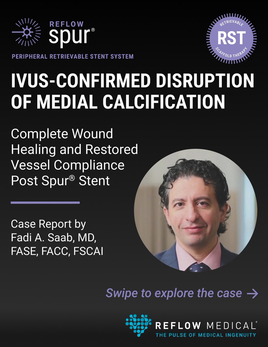 reflowmedical's tweet photo. Heavy medial calcification and significant soft plaque made this CLTI case challenging and typical of real-world BTK disease.

This new case report shows how the Spur® Stent System achieved IVUS-confirmed disruption of medial calcification and supported complete wound healing in a peroneal artery lesion treated by @FadiSaab17 Fadi Saab, MD, FACC, FSCAI, FASE.

A 51-year-old male (Rutherford Class 5) with Type I diabetes and a prior kidney transplant presented with minor tissue loss of the 4th digit and a 50 mm peroneal artery lesion with heavy medial calcification, soft plaque, and 76% stenosis. After predilatation, a 3.0 × 65 mm Spur Stent was used.

IVUS post-treatment demonstrated disruption of the medial calcium ring with restored vessel pulsatility and compliance.

Outcomes:
• Complete wound healing at 3 months
• Rutherford Class 0 through 12 months
• Patency at 6 and 12 months (duplex)

📄 Read the full case report below or on our website:
https://t.co/XsWbkfhaAT

#PAD #CLTI #vascular #SpurStent