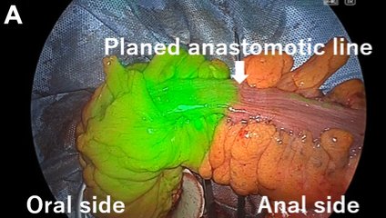 almagoch's tweet photo. Evaluación cuádruple de @SWexner para #anastomosis colorrectal: 
1. Prueba neumática
2. #Endoscopia intraoperatoria
3. Angiografía con verde de #indocianina.
4. Revisión de las donas 🍩
Reduce significativamente la incidencia de fugas anastomóticas. #Cirugía #Cirujanos https://t.co/BkfI4x8n7n