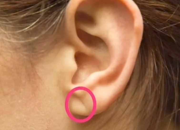 nervemed's tweet image. Which condition is most associated with this clinical feature❓

A. Aortic Regurgitation
B. Coronary Artery Disease
C. Temporal Arteritis
D. Hyperlipidemia