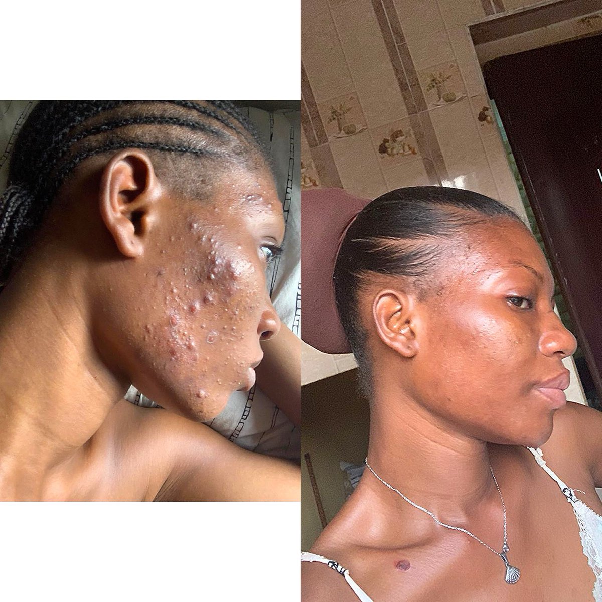 mos_beautyhub's tweet image. From severe acne to clear, acne-free skin all with the Mo Skincare Acne Face Set.

#moorganics #mosbeauty #happycliënt #acnefree #acne #results #review