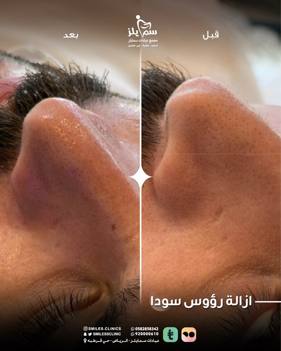 تنظيف بشرة بالهيدرافيشيل 🤍