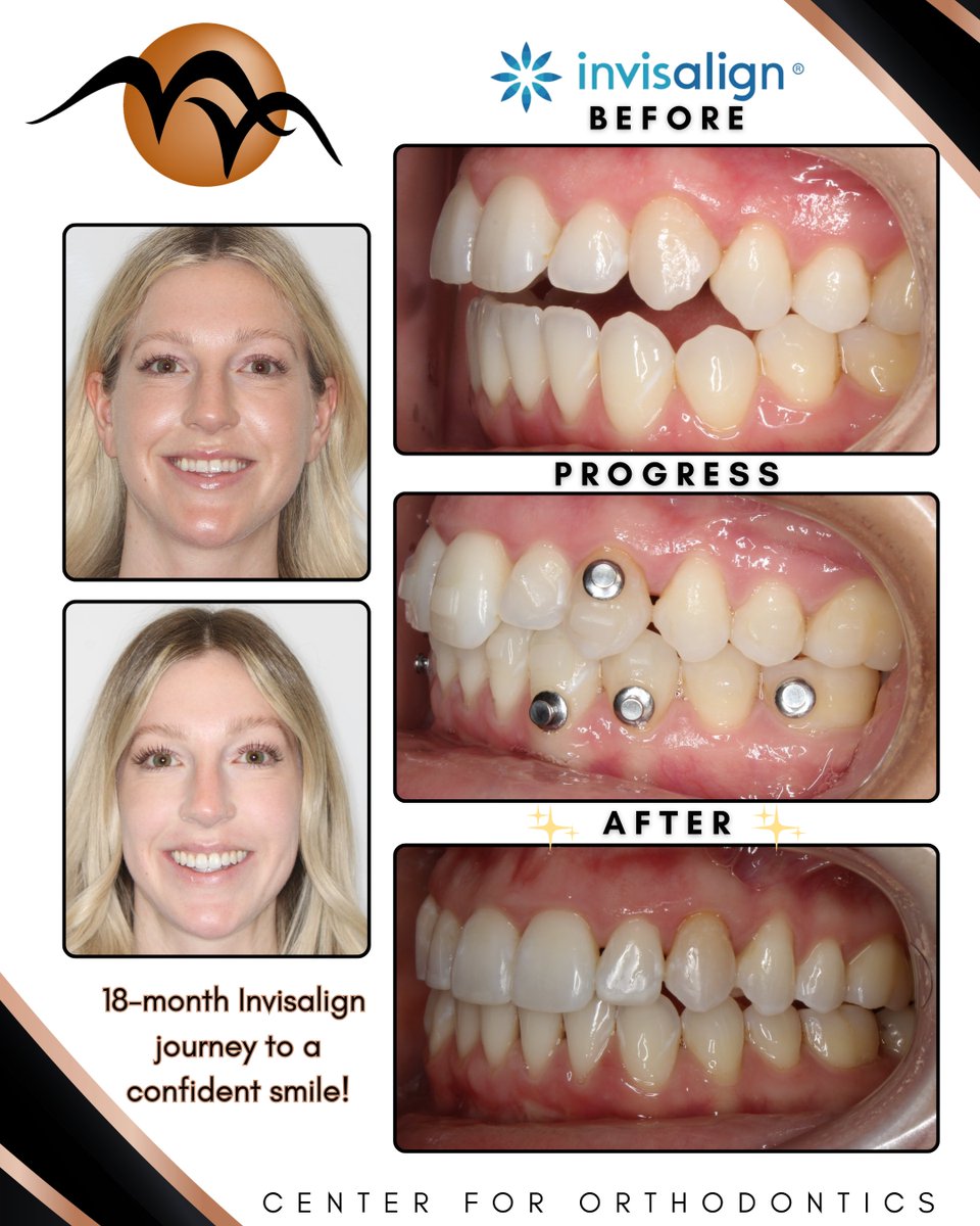 drminanarula's tweet photo. Transformation time! ✨✨
This beautiful smile was achieved with Invisalign! We are so proud of our patient's dedication and amazing results. Contact us to get your journey started. #beforeandaftersmiles #invisalignjourney #smilereveal #centerfororthodontics https://t.co/CeLtWfnnPV