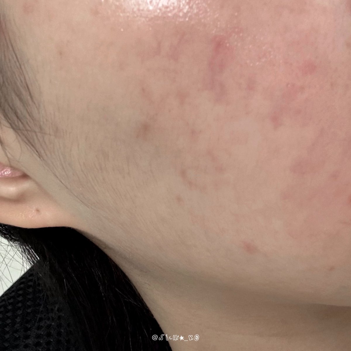 sicha_ko's tweet image. 피부 복구 완.

해달씨 폼클 평생 쓸게요 홍조랑 붉은기 가라앉은 거 보이시죠? 바이럴 아님 돈 받은 거 없음