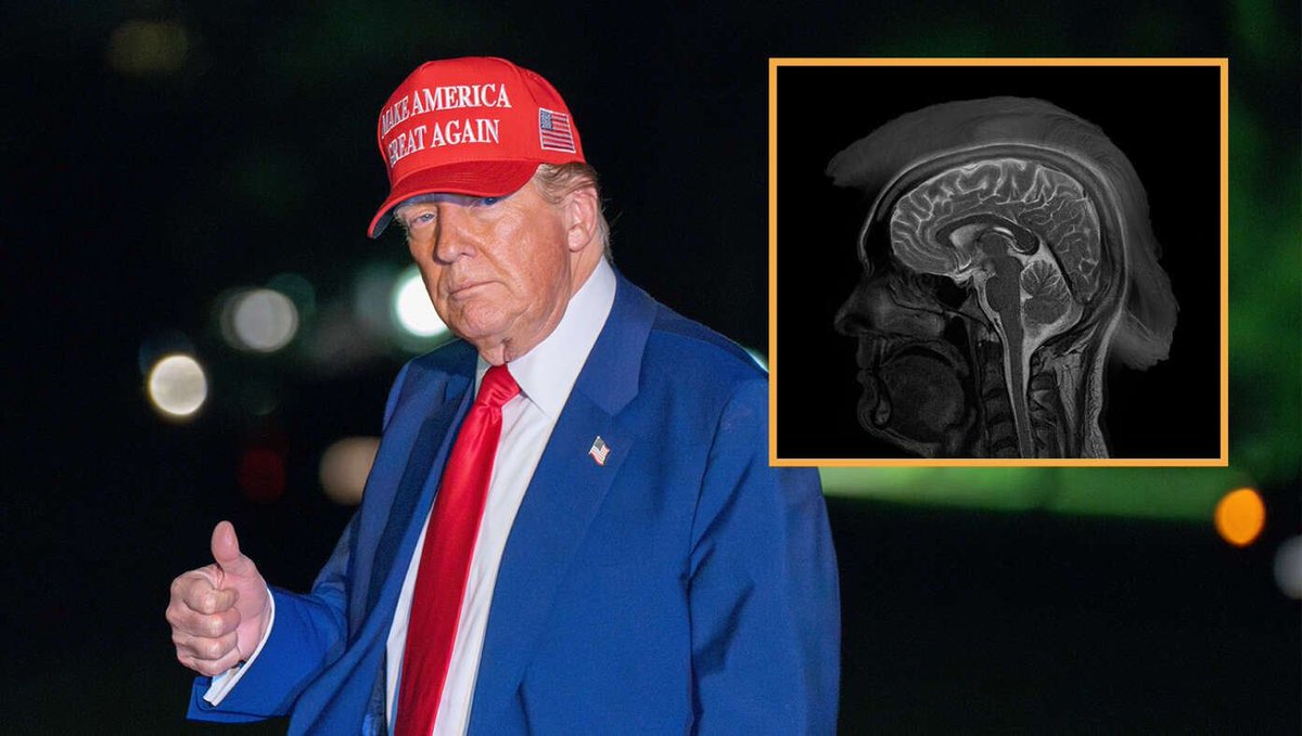 MRI Confirms President Donald Trump Has Incurable Advanced-Stage Patriotism buff.ly/T1KmHmH