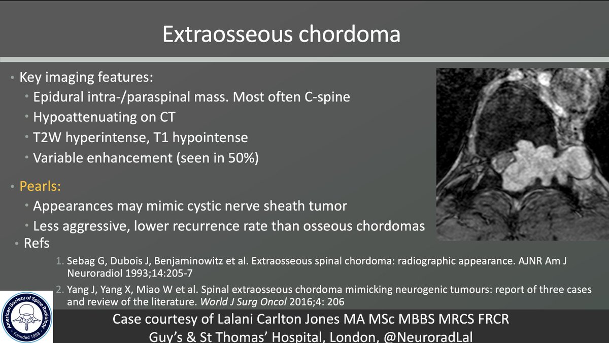 The_ASSR's tweet image. ASSR COTW

History: Progressive spinal pain and Paresthesia

Case c/o Lalani Carlton Jones

#SpineRad #NeuroRad #MedEd #FOAMed #FOAMrad #neuroradiology #radiology