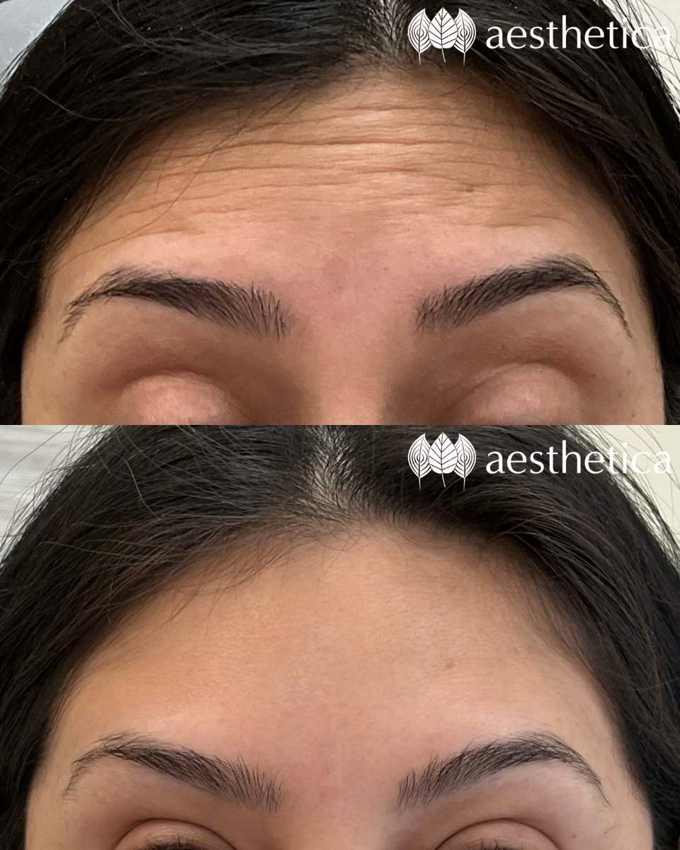 We never get tired of Botox before and afters 🤩🙌💉