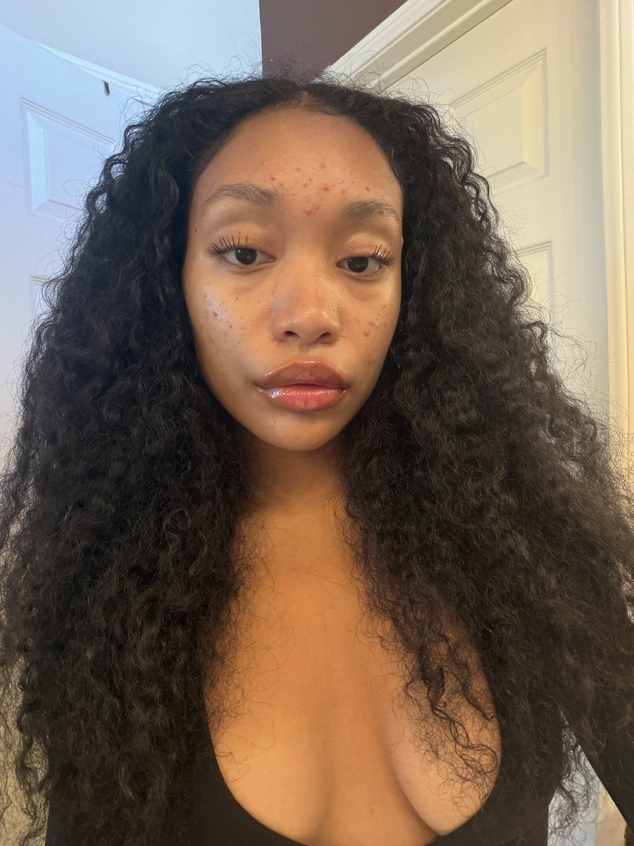 he4vin's tweet photo. why sometimes the acne make me prettier pt 2 https://t.co/JvZtE9Rhlj