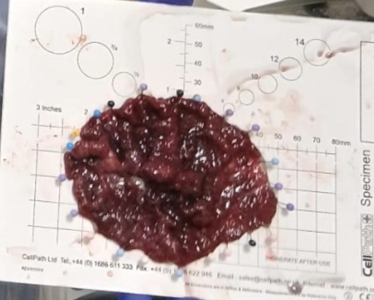 Prevention remains the most powerful tool in fight against cancer. Incredible to see the groundbreaking work in 3rd-space endoscopy at  <a href="/MFTnhs/">MFT NHS</a> 
<a href="/WythenshaweHosp/">Wythenshawe Hospital</a> Manchester 
#Pushing boundaries in  minimally invasive options for our patients!!!