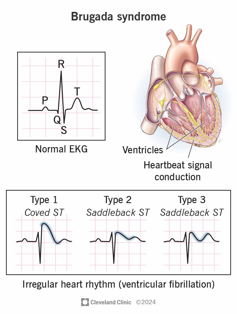 TrackYourHeart's tweet photo. Brugada Syndrome: A Silent Threat to the Heart

What is Brugada Syndrome?
Brugada syndrome is a potentially fatal genetic disorder that affects the heart’s electrical system. It increases the risk of sudden cardiac death, often during sleep. The most common cause is a mutation in the SCN5A gene, which disrupts sodium channel function and cardiac conduction.

Brugada Pattern vs Brugada Syndrome
🔲 Brugada Pattern:
- An incidental ECG finding in people without symptoms.
- Often triggered by fever, certain medications, or electrolyte disturbances.
- Managed with monitoring and avoidance of triggers.

🔲 Brugada Syndrome:
- ECG abnormalities plus symptoms such as syncope, palpitations, or cardiac arrest.
- Carries a high risk of sudden death and requires prompt intervention.
- Management includes ICD implantation or treatment with quinidine.

Types of Brugada ECG Patterns
🔵Type 1 (Diagnostic): Coved-type ST elevation in V1–V3.
🔴Type 2: Saddleback ST elevation.
🔴Type 3: Mild or incomplete features of Type 1 or Type 2.

Differential Diagnosis
Conditions that can mimic a Brugada pattern include:
◽Right bundle branch block
◽Early repolarization
◽Acute pericarditis
◽Arrhythmogenic right ventricular cardiomyopathy
◽Electrolyte abnormalities such as hyperkalemia
◽Ischemic heart disease
◽Pectus excavatum (where chest wall anatomy alters lead placement)

Key Features to Remember
1️⃣ Genetics: A sodium channelopathy with autosomal dominant inheritance and strong familial patterns.
2️⃣ Symptoms: Syncope, ventricular tachycardia, ventricular fibrillation, and sudden nocturnal death.
3️⃣ECG: Coved ST elevation with T-wave inversion in V1–V3.
Sources: @MayoClinic @ClevelandClinic
