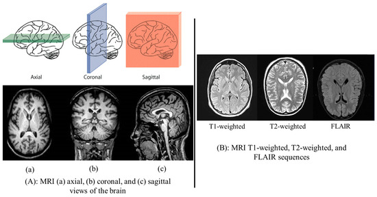 Sensors_MDPI's tweet image. Advanced Deep Learning and Machine Learning Techniques for MRI Brain Tumor Analysis: A Review
mdpi.com/1424-8220/25/9…
#MRI #deep_learning