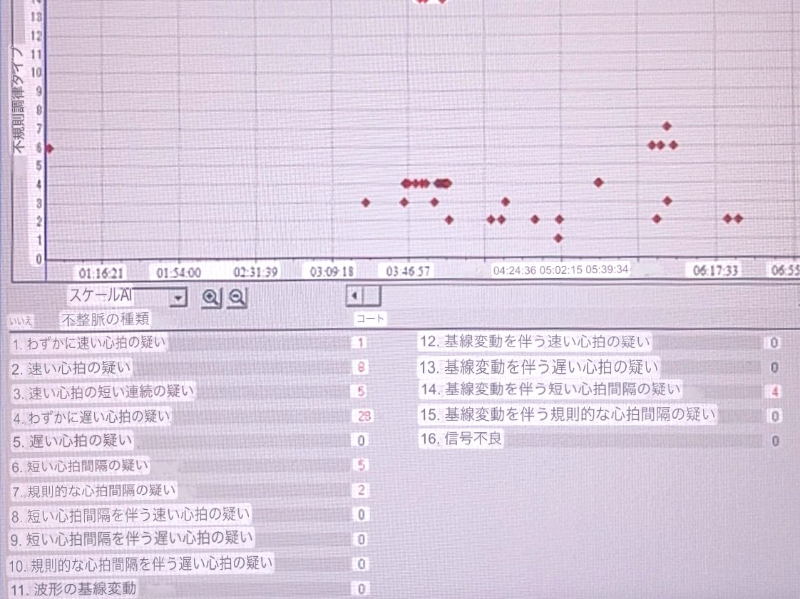 寝てるとき不整脈いっぱい