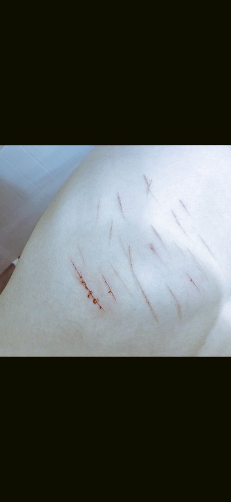 sharkiegillz's tweet photo. rib n neck cuts from a couple months ago super small and insignificant tho, I want to cut my neck again tbh but im too pussy to do it shtwt 988twt cuttwt gilltwt ouchietwt catscratchtwt https://t.co/aBbOjhkmAf