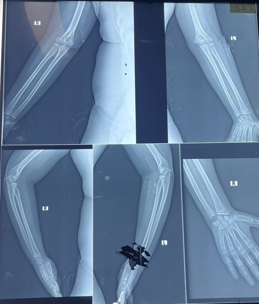 KumarAd23189942's tweet photo. An eleven year old boy fell and felt pain in his leg. He also noticed a lump during that time. The lump is Painless.  Xrays are shown.  DDs and most probable Dx?
#medtwitter 
#medex 
#inicet 
#orthopedicsurgery https://t.co/qaLJC921yi