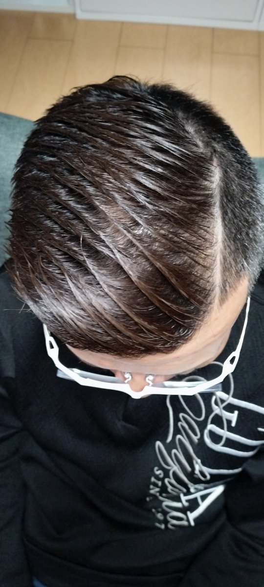 フィナステリド＋ミノ、5ヶ月目突入
整髪料つけてもだいぶわからなくなってきた
最初の1ヶ月が副作用で頭痛あったけどあとは無し、体毛濃くなったくらいw