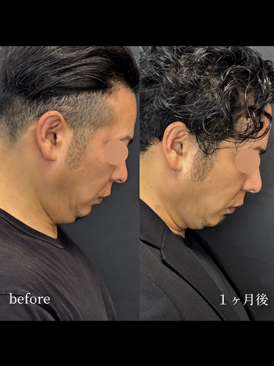小林先生/耳鼻科専門医/顎下脂肪吸引 tweet media