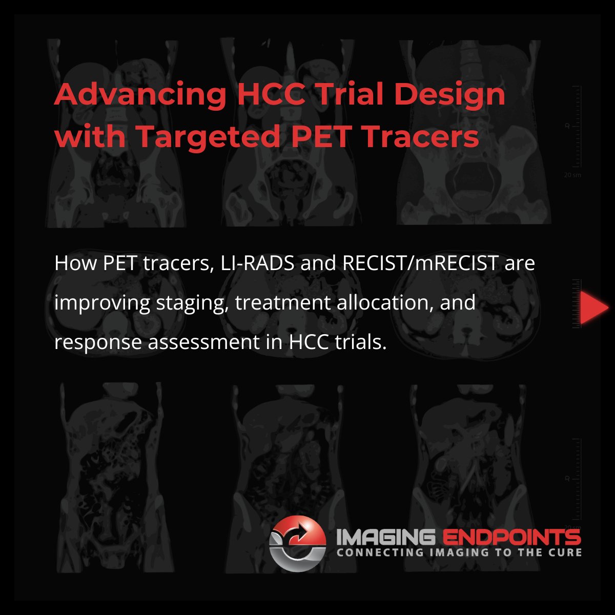 ImagingEndpoint's tweet photo. HCC’s rising mortality makes precise imaging essential in trials. Integrating targeted PET tracers with LI-RADS and RECIST/mRECIST improves staging, treatment allocation, and early response assessment.

Read more: https://t.co/IFJxOt7Ec5

#HCC #OncologyTrials #MedicalImaging https://t.co/xMoA2KyiWD