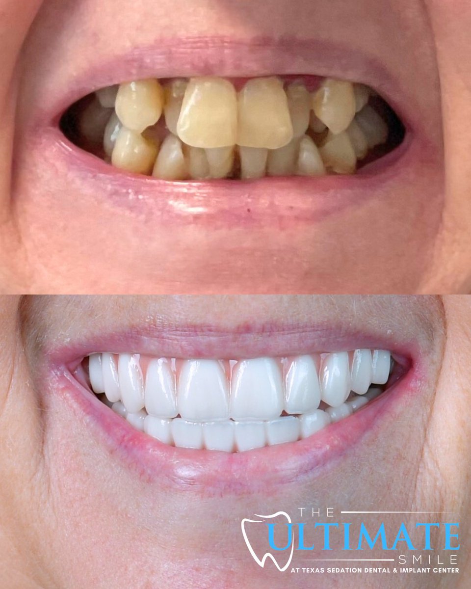 TXSedationDent's tweet image. We love helping our patients feel confident, happy, and proud of their smiles. From the very first Ultimate Smile Assessment to the final Ultimate Smile reveal, every step is about restoring confidence and creating results that truly shine.

#DentalImplants #FixedTeeth #Dentures