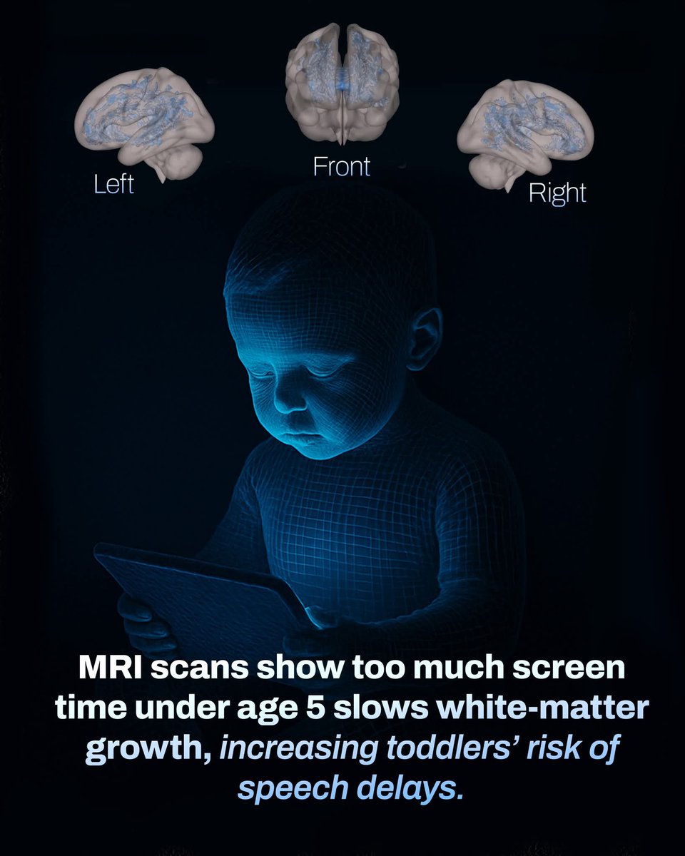 ShiningScience's tweet image. Excessive screen time before age five has been linked to slower growth of white-matter pathways in the developing brain. These pathways are essential for language, literacy, and cognitive processing, making their healthy development crucial during early childhood. MRI scans…