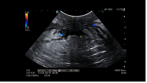 BowelUltrasound's tweet photo. A 24-year-old woman with known ileal Crohn’s disease presents with perianal pain and fever for 5 days. Reporting increased stool frequency and mild abdominal discomfort. No prior perianal surgery / On adalimumab with partial response. What are the findings on TPUS: https://t.co/6oL7Uy7Kvs