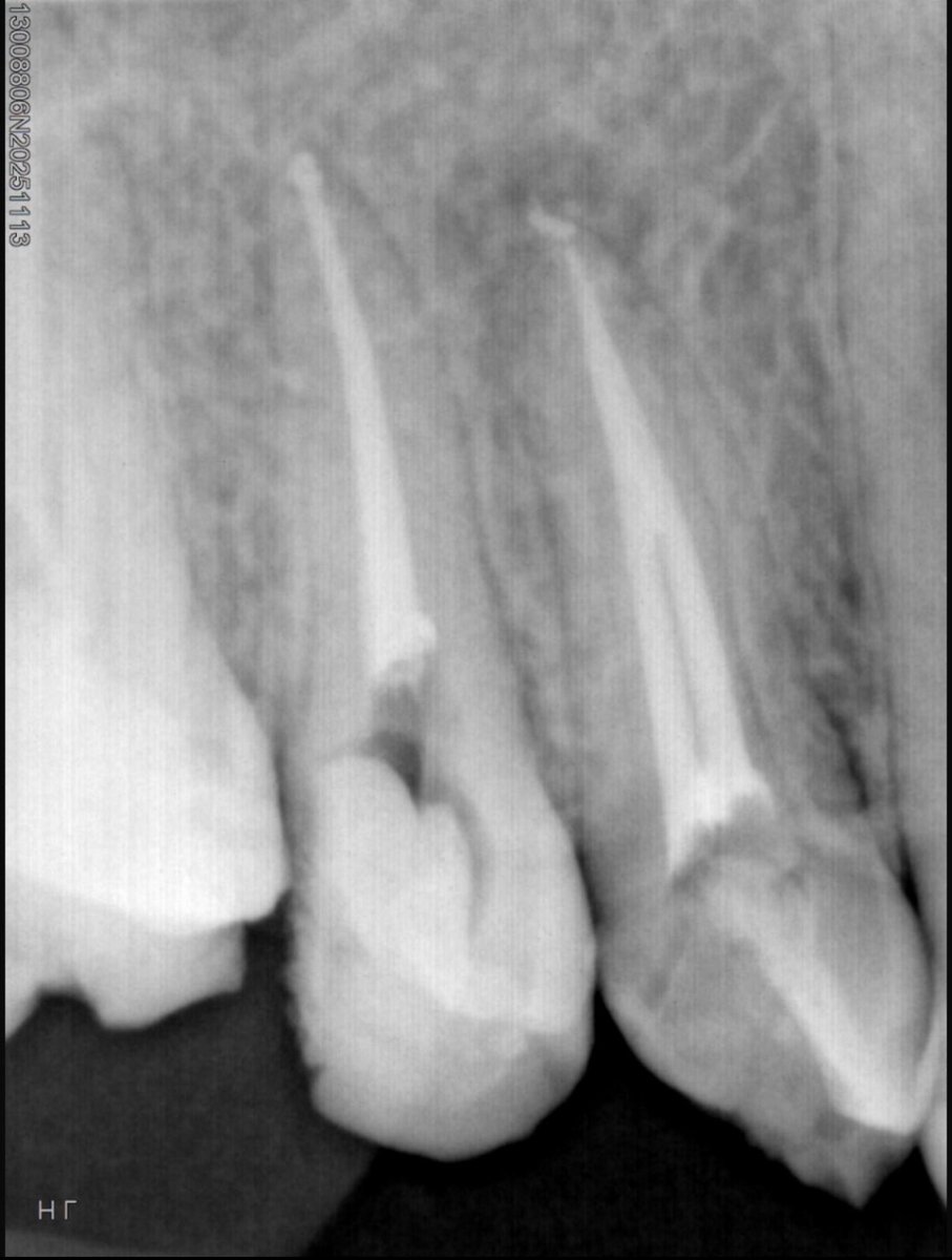 A__HUB's tweet photo. Last week Endo cases: 

1- RCT for 26

2- RCT for 46

3- rRCT for 14,15 https://t.co/VwDkT9WAQk