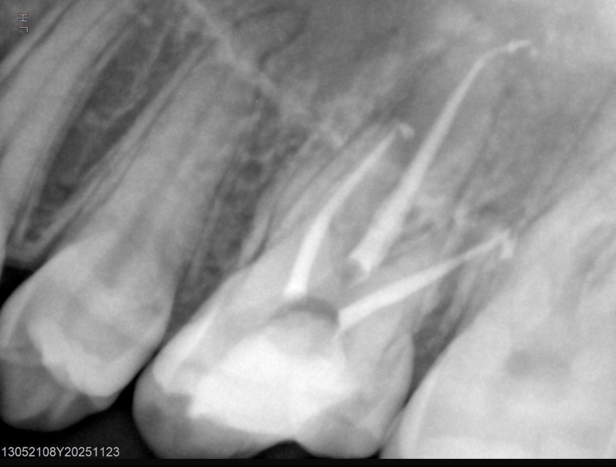 A__HUB's tweet photo. Last week Endo cases: 

1- RCT for 26

2- RCT for 46

3- rRCT for 14,15 https://t.co/VwDkT9WAQk