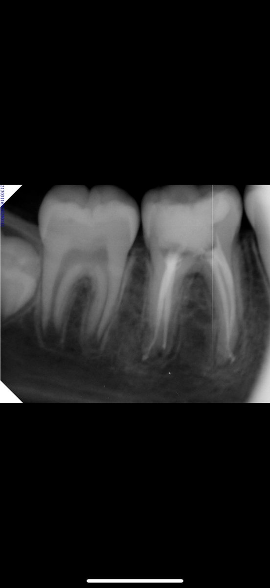 A__HUB's tweet photo. Last week Endo cases: 

1- RCT for 26

2- RCT for 46

3- rRCT for 14,15 https://t.co/VwDkT9WAQk