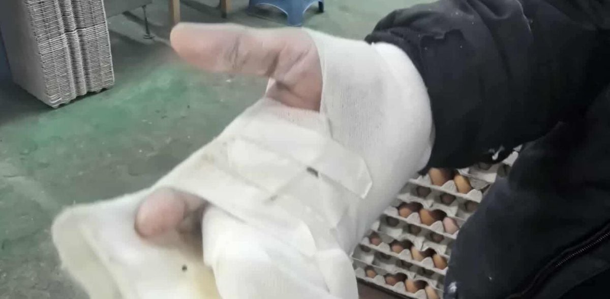 ThaigerNews's tweet image. A Thai man working illegally at a chicken farm in South Korea lost two fingers in an accident—and says his boss still hasn’t paid compensation. Aum Farida Ma, who supports Thai migrants, says even undocumented workers are legally insured. #Thailand #SouthKorea #MigrantWorkers