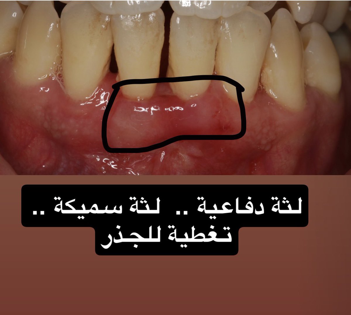 تغطية جذور الأسنان المكشوفة الناتجة عن تراجع (انحسار) اللثة يتم عن طريق زراعة اللثة

الهدف: بناء لثة دفاعية سميكة لإيقاف الانحسار وتغطية الجذور (حسب درجة الانحسار)

الصورة توضح لثة رقيقة وانحسار لثوي
النتيجة بعد الإجراء: لثة دفاعية سميكة صحية
#لثة #زراعة_أسنان <a href="/Dr_Hussam_Perio/">Dr. Hussam Alqahtani</a>