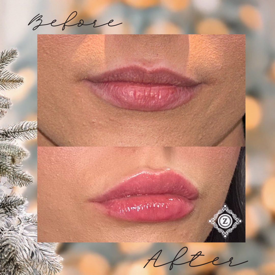 This holiday season, treat yourself (or someone special!) to the perfect pout.
Buy 1 syringe of lip filler and receive a FREE Lip Flip + Vitamin C Lip Treatment — an $82 value!💜🎄✨🎁

Natural, beautiful lips… just in time for the mistletoe. 💋✨
