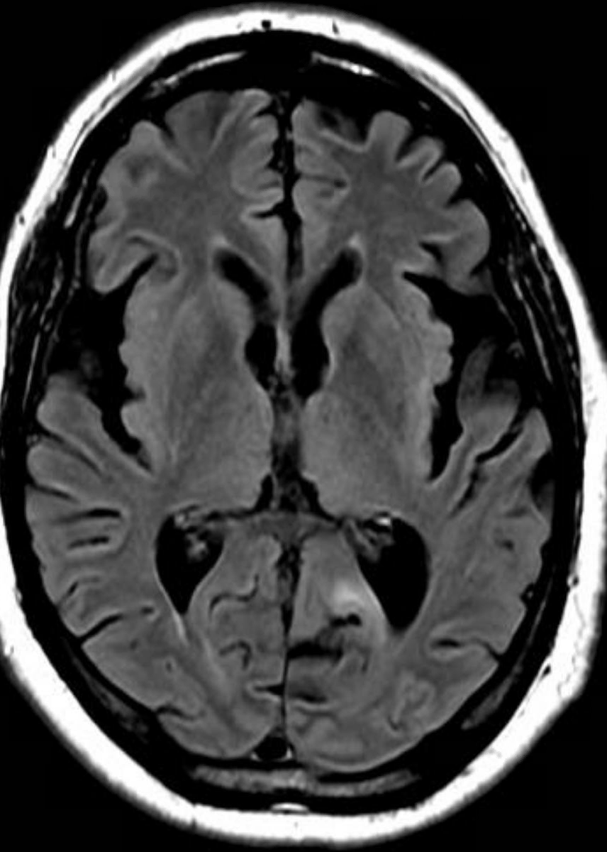 Here is an interesting case.
Another reminder that a good diagnostician never relies on a single piece of data to make a diagnosis. Your job is to integrate all the clues. A lab value doesn’t make the diagnosis. A radiologist doesn’t make the diagnosis. You do.
Sherlock Holmes