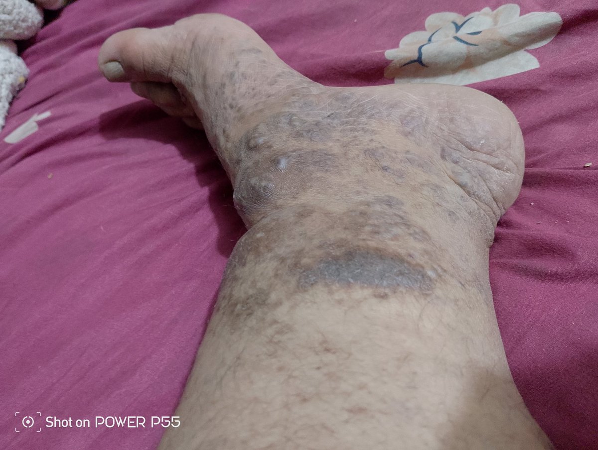 Rans5569's tweet photo. @JoelKatz Sir, please help me. Donate to save my life. I'm crying from the pain. I've been completely paralyzed in my leg for two years and I can't walk. The doctors are asking me for 100,000. Please, sir, donate to me. Don't just watch in silenceI want 50,000 XRP coins grain Please, sir https://t.co/13mCbsVGDS