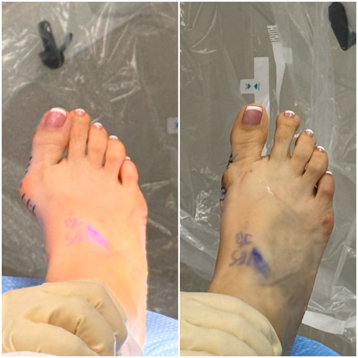 Fusion_Ortho's tweet photo. Stability. Confidence. Results.
#FusionOrthopedics #EverythingBetter #FootAndAnkleSurgery #Orthopedics #PodiatricMedicine #SurgicalInnovation #PatientOutcomes #MiniLock #MinimallyInvasive #OrthopedicSurgery #DPM https://t.co/Ha6xu9Vnjs