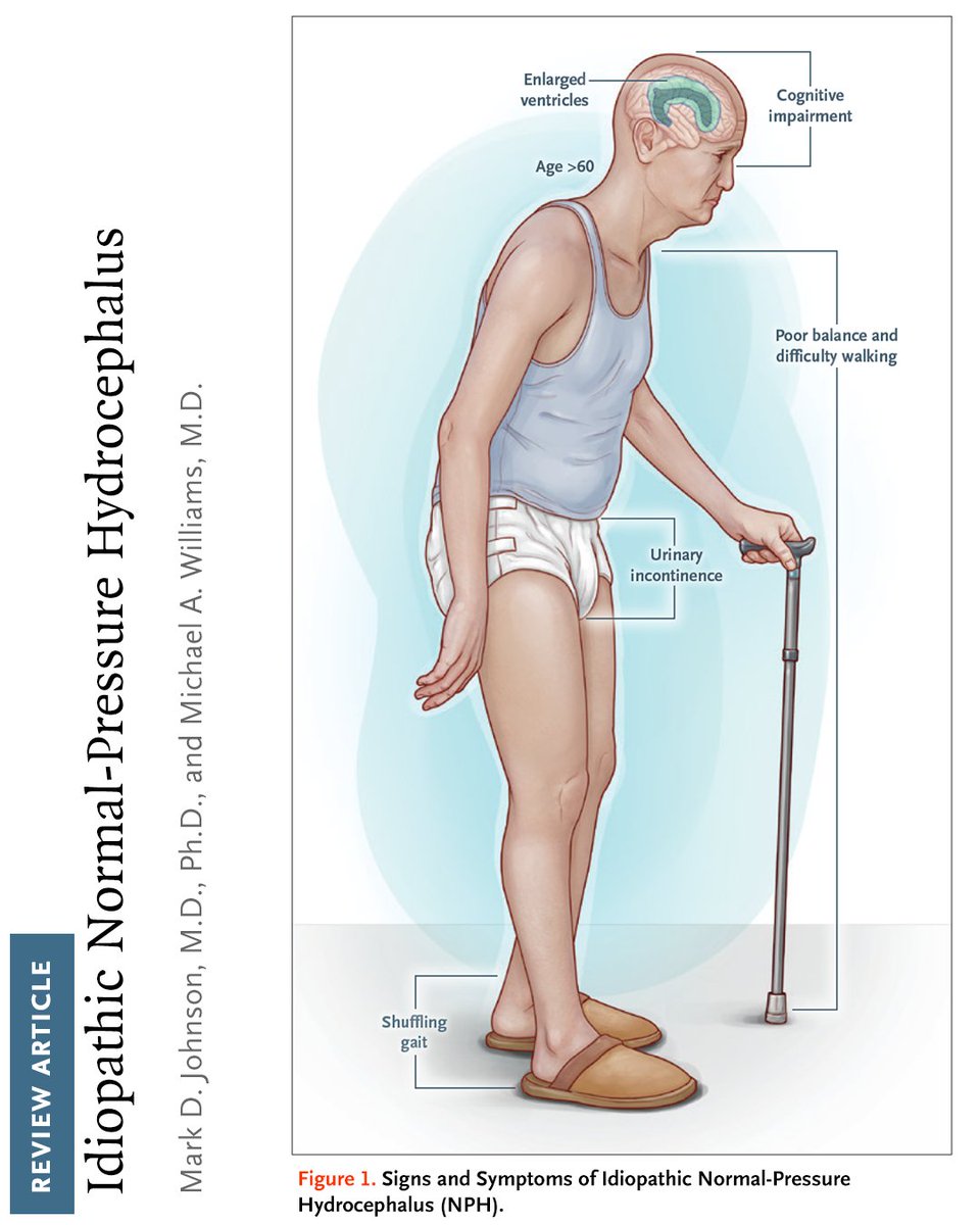 NEJM's tweet image. Idiopathic normal-pressure hydrocephalus (iNPH) typically causes gait, cognitive, and urinary impairment. The diagnosis is aided by a medical evaluation, imaging findings, and tests that predict improvement with CSF shunting.  

Learn more in the Review Article “Idiopathic…
