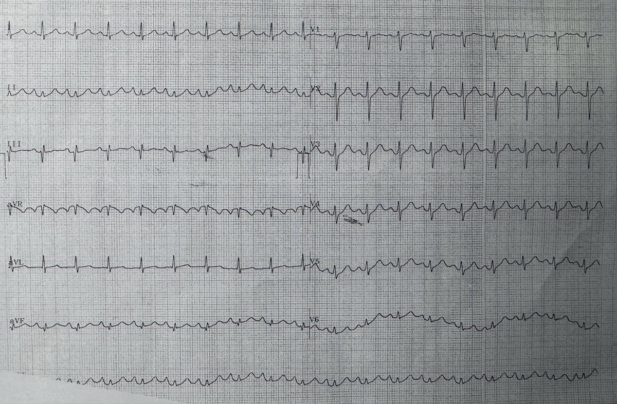 iBurhanMD's tweet photo. 55 year old man with syncope.
#Cardiovascular #MedTwitter #Cardiology #CardioEd #CathLab #Radiology #radiologycases #CardioTwitter #MedicalEmergency #MedicalStudents #MedicalEducation #EKG #ECG #Paramedics #STEMI #OMI #Cardiologist #ecgbot #ACS #Pulmonaryembolism https://t.co/8uCm1oGayZ