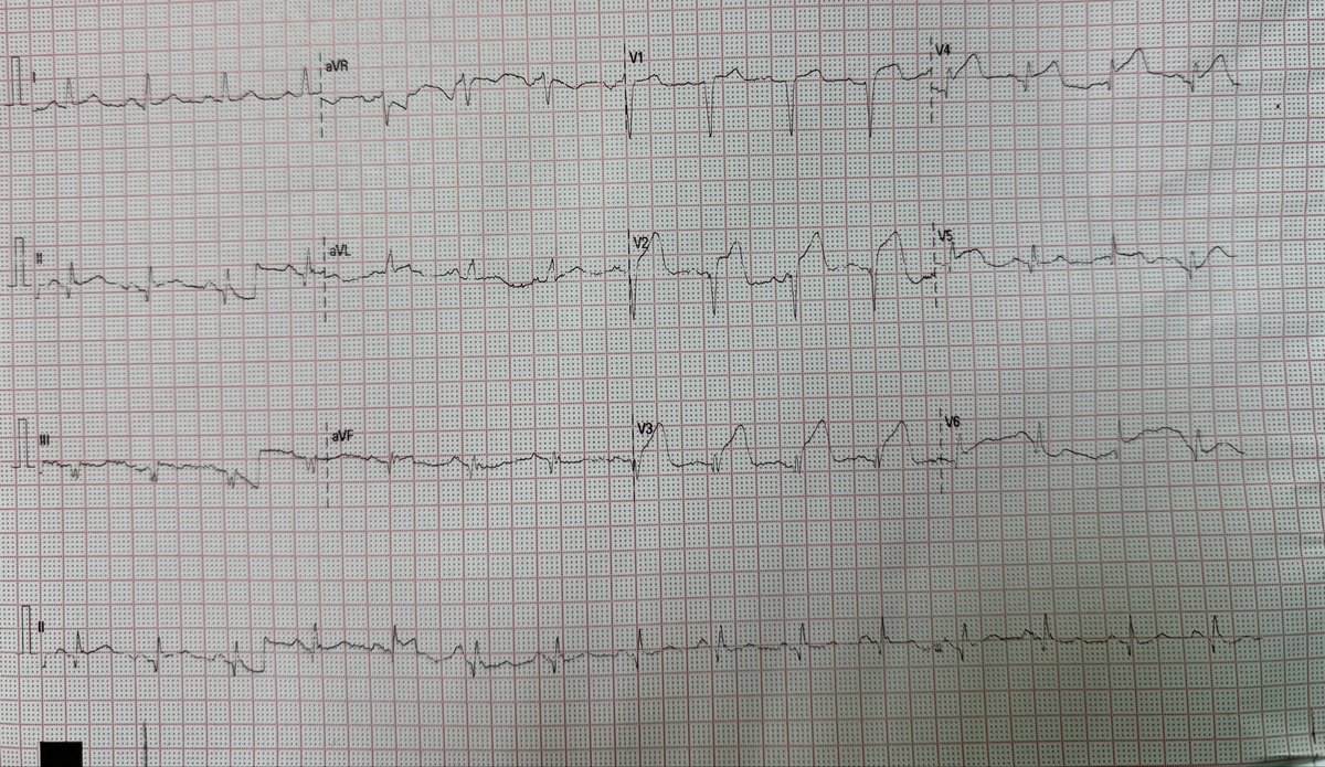 iBurhanMD's tweet photo. 46 year old with chest pain.
#Cardiovascular #MedTwitter #Cardiology #CardioEd #CathLab #omi #Catholic #CardioTwitter #MedicalEmergency #MedicalStudents #MedicalEducation #EKG #ECG #Paramedics #STEMI #OMI #Cardiologist #ecgbot #ACS #ecgrhthm https://t.co/VJcQKxdK8x