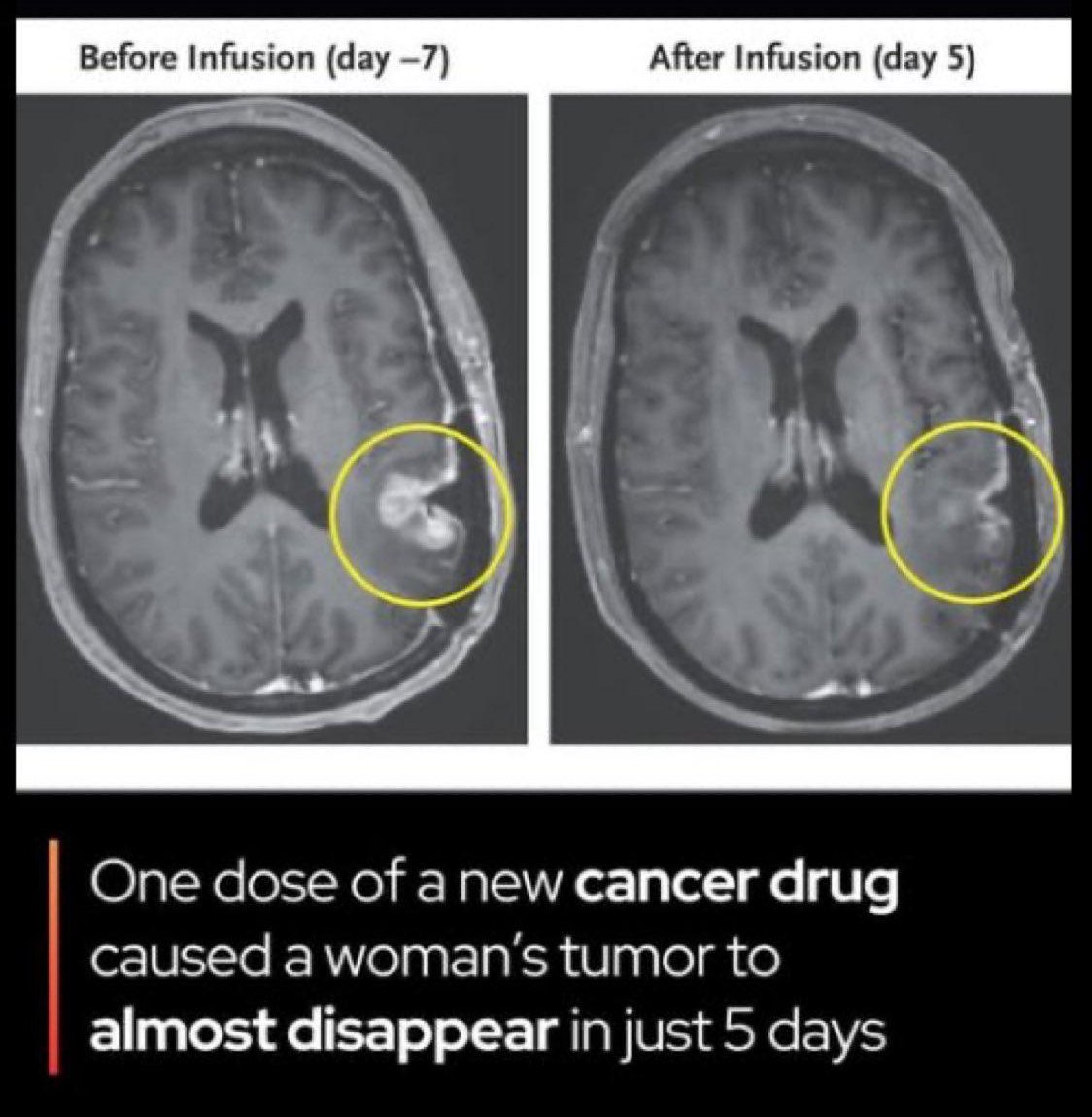 MAstronomers's tweet image. A single dose of a new cancer drug made a brain tumor almost disappear - in just 5 days. 

In early 2024, doctors at Massachusetts General Hospital treated three people with recurrent glioblastoma brain tumour using a brand-new type of CAR T-cell therapy called CARv3-TEAM-E.