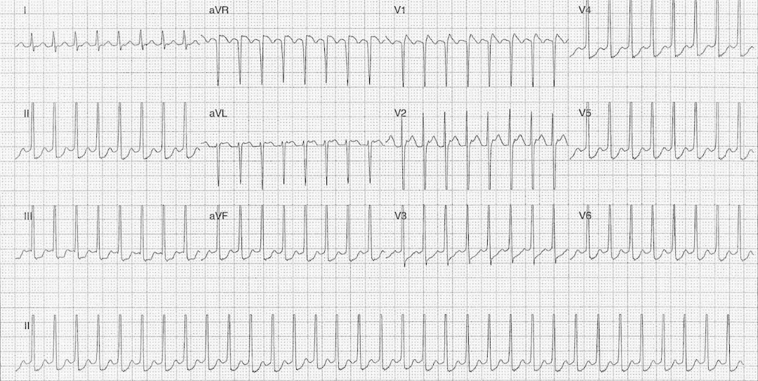 <a href="/ldtRUrmTtt28043/">にしうらならお</a> <a href="/_KyangoshiDayo_/">おかか</a> <a href="/nyans5hiki/">心電図修行中</a> #心電図戦士11【10戦目⑨先天心】No.99
おはようございます。私からの最後の出題。

10歳男児、軽い喘鳴と息切れで受診。
Bp:105/60 KT:36.4 SpO2:99%
既往に喘鳴あり発達上は問題なし
サルブタモールを必要時吸入中

これはAVRT？AVNRT？
(次に選択肢を付けてます)