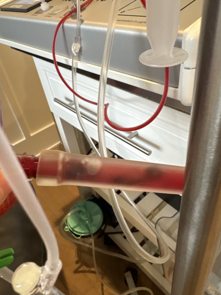 Did you know that you can remove blood clots, microplastics, heavy metals, biofilm, bacteria, fungi, viruses, and even COVID spike proteins from your blood/body doing just an hour long IV?

It’s called EBOO.

It incorporates a form of oxygen called ozone, and has been around