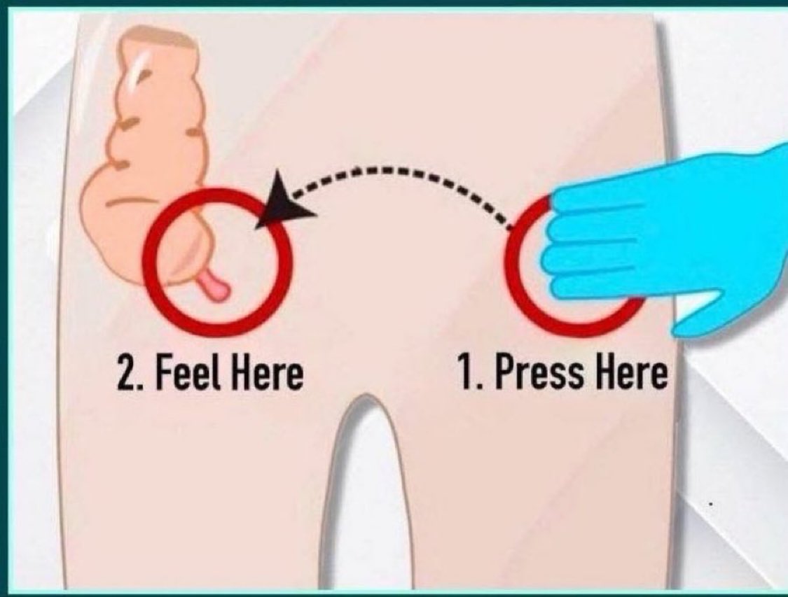 Doctors__squad's tweet photo. A doctor presses on the patient's left lower quadrant and observes pain in the right lower quadrant, as shown in the diagram. What is the name of this clinical sign used in the diagnosis of appendicitis?

A. McBurney's sign
B. Rovsing's sign
C. Psoas sign
D. Obturator sign https://t.co/R0cesd1yZm