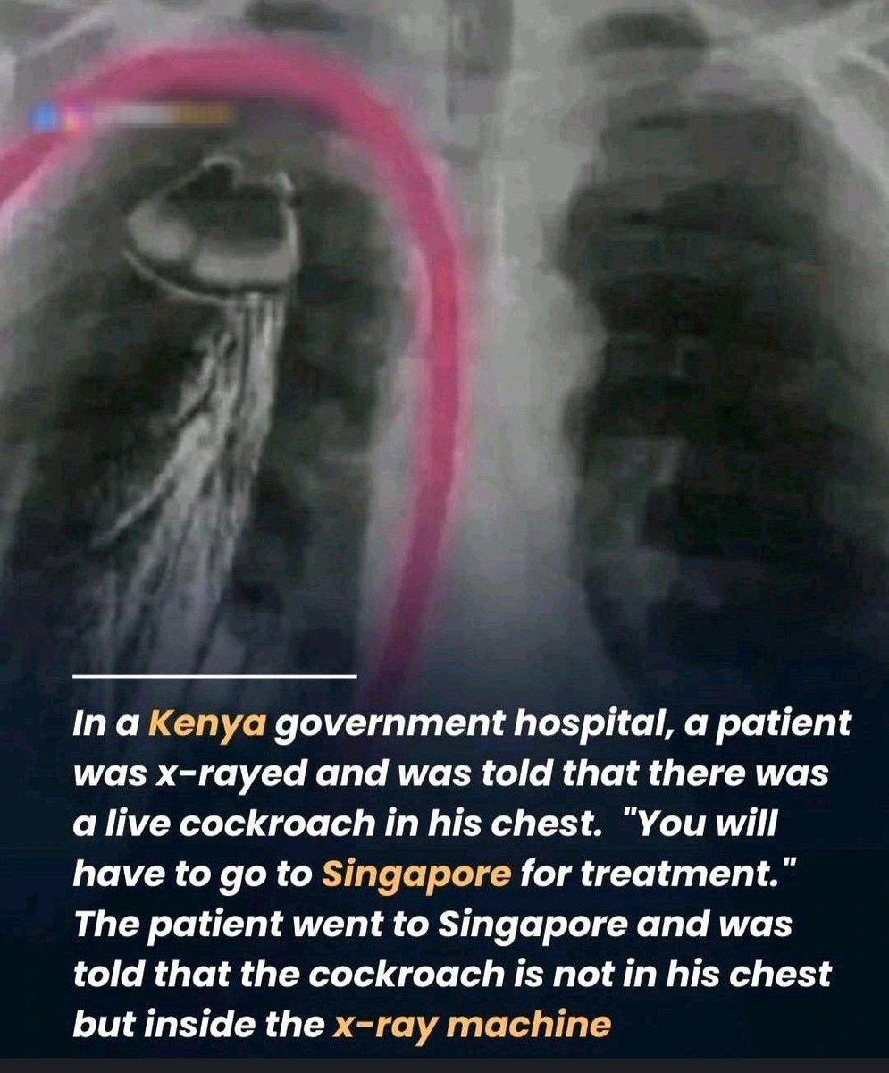 In a Kenya govt hospital, a patient was x-rayed and was told that there was a live cockroach in his chest "You will have to go to Singapore for treatment" 
The Patient went to Singapore and was told that the cockroach is not his chest but inside the x-ray machine.