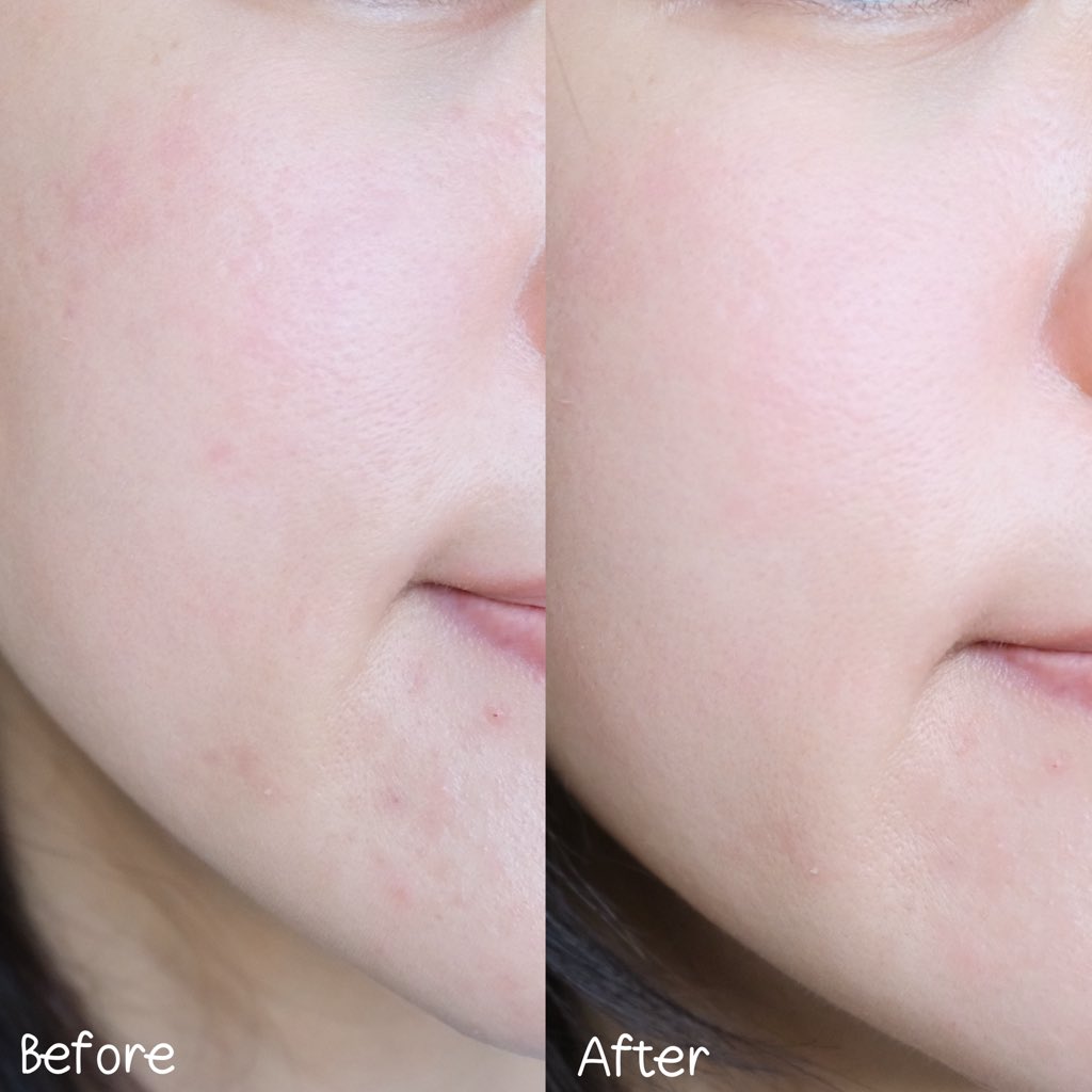 ช่วงก่อนผิวแหก ผิวเป็นสิวแบบไม่ไหวแล้ว เหมือนลองอะไรก็ยิ่งระคายเคือง จนดีขึ้นเลยรวม 3 ตัวที่ใช้ ที่ช่วยประคองผิวตอนกลางคืนให้กลับมานุ่มขึ้น สิวสงบลง และไม่พังหนักกว่าเดิม รวมไว้ข้างล่างแล้วนะ  👇