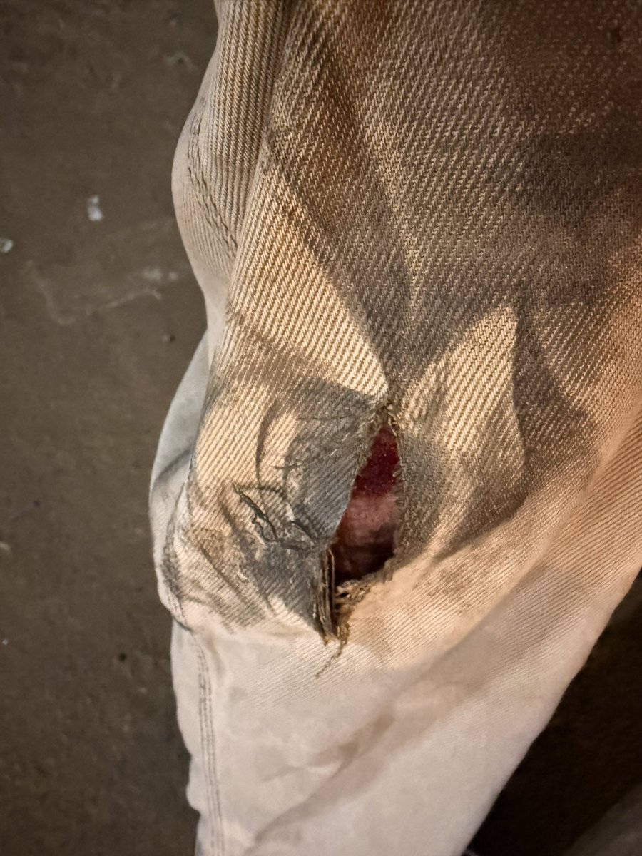 daniyalm1300's tweet image. Last week, I went through a deeply concerning experience with a @rapidobikeapp ride. The driver was driving so rashly that we ended up in an accident. I sustained injuries, my clothes were torn, my phone’s back cracked, and the driver actually abandoned me on the flyover.