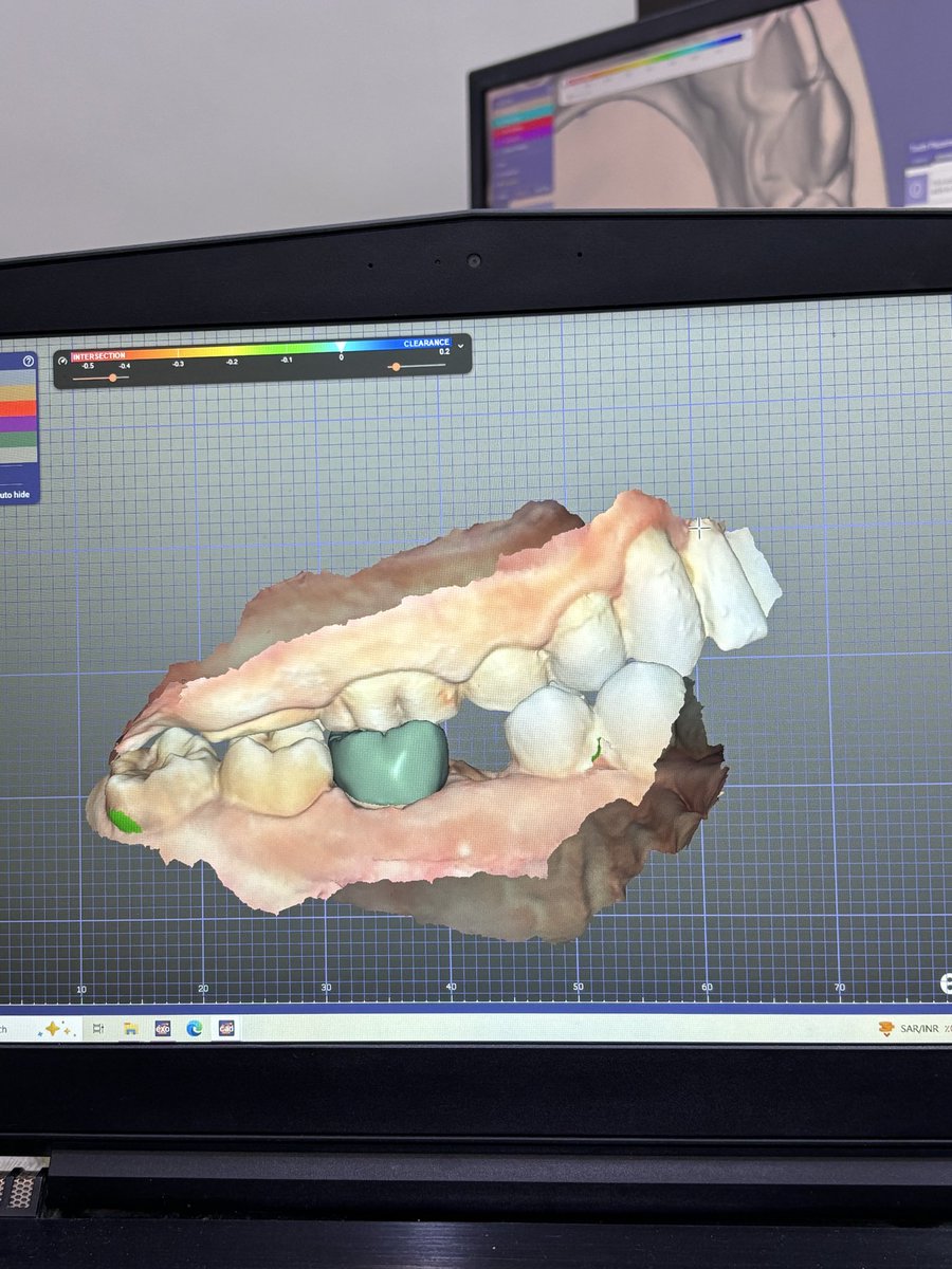 Digital workflow : IOS scan + Exocad design.