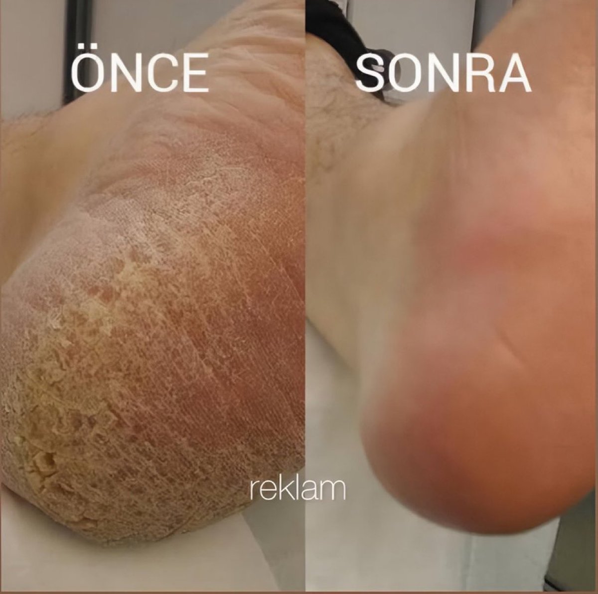 akil_tozu's tweet image. Ayağında mantar, ölü deri ve çatlak olanlar için harika bir krem öneriyorum😳

Kararmış ayakları beyazlatır, ölü deriden arındırır ve kötü kokuyu giderir.💯👌