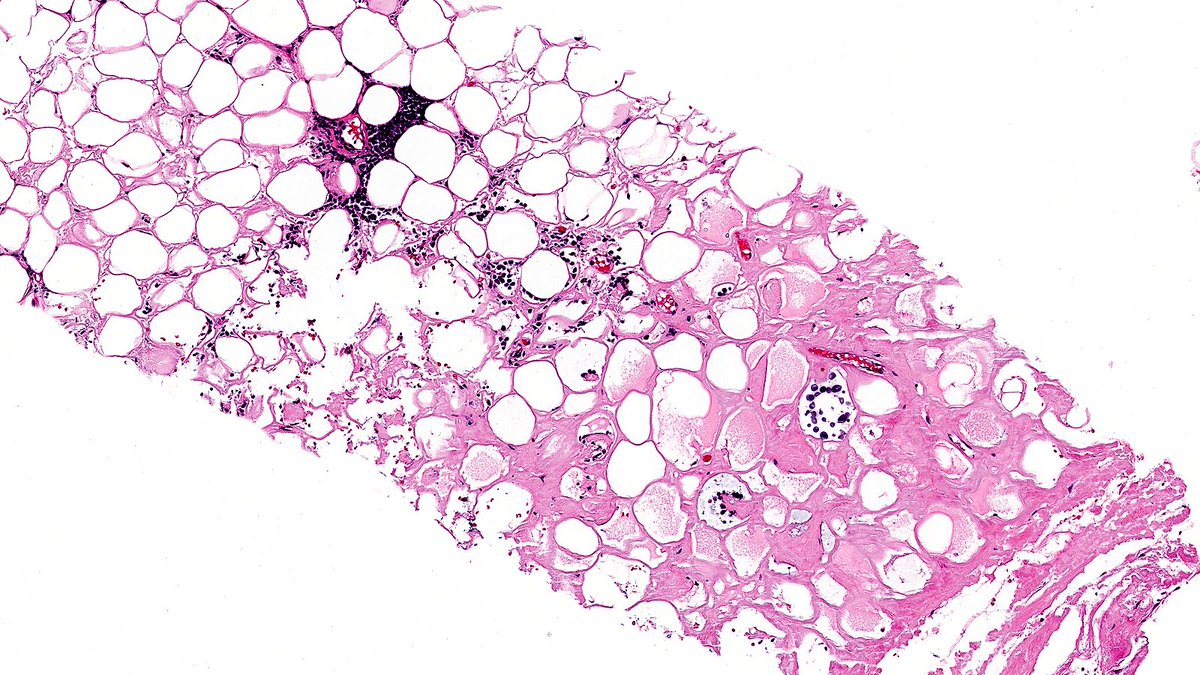 RazaHoda's tweet photo. Case of Amyloid Deposition in Breast 🤒🔬

Breast amyloidosis is rare and can represent localized disease, a manifestation of systemic inflammatory disorders, or even be associated with underlying lymphoid neoplasia.

#PathX #PathTwitter #breastpath https://t.co/RareI5b2Xw