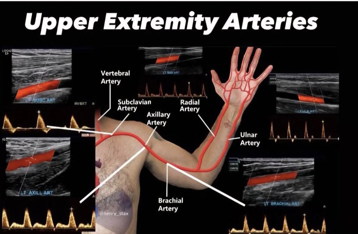 mznljrdy47597's tweet image. Upper Extremity Arteries – Ultrasound Overview
This graphic demonstrates the major arterial pathways of the upper limb, starting from the Subclavian and Axillary Arteries, continuing distally through the Brachial, and dividing into the Radial and Ulnar Arteries. 
#ultrasound