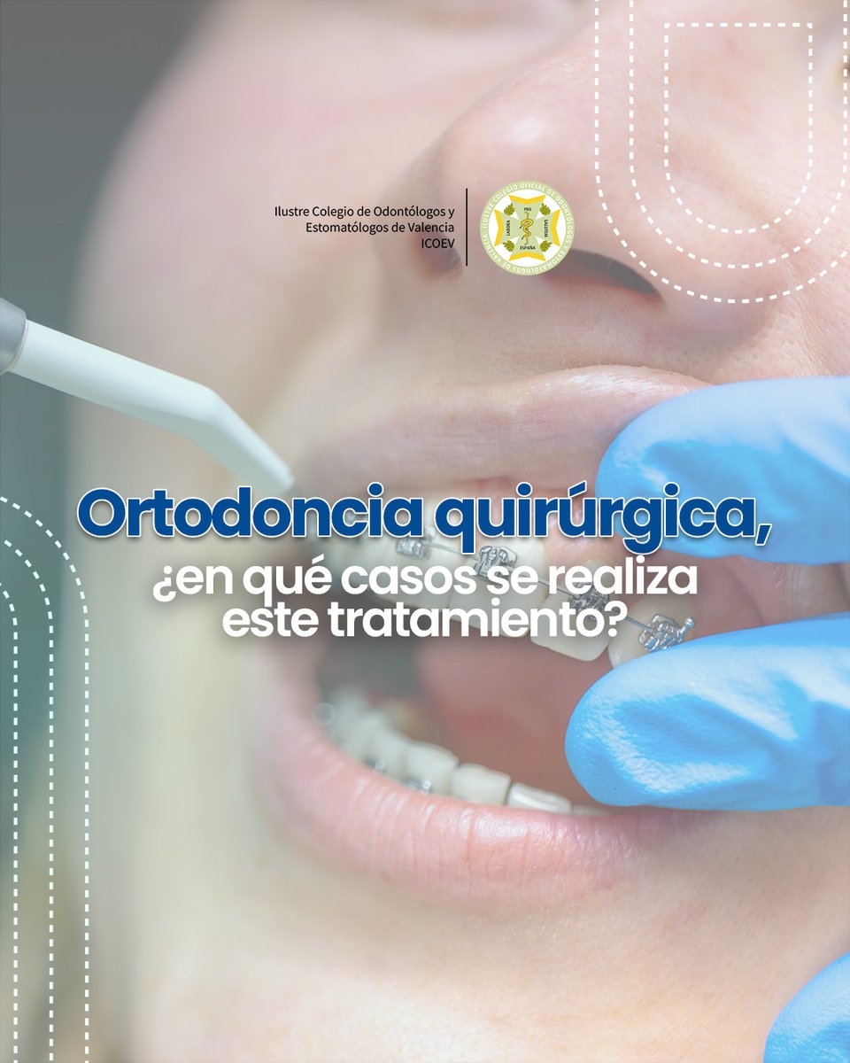 La ortodoncia quirúrgica va mucho más allá de alinear dientes. Cuando existe un problema esquelético, ya sea en el maxilar, en la mandíbula o en ambos, los brackets o alineadores por sí solos no son suficientes.