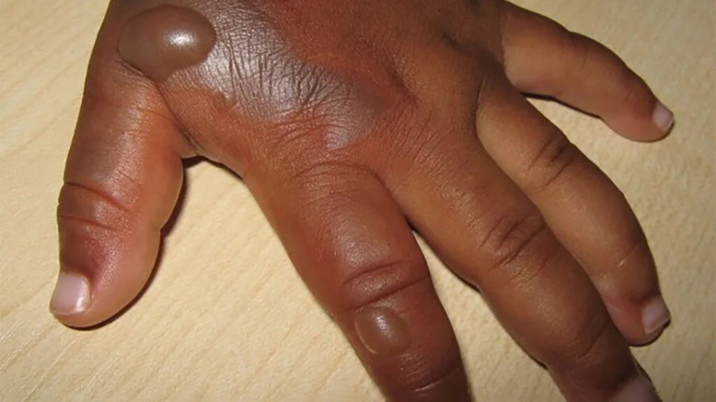 Nig_Farmer's tweet photo. #NaijaFarmerTips 

Have you ever gotten a burn from hot water, fire, or a hot surface? 
Instead of panicking, one thing you can actually start looking for is the snail shell powder.

This is one simple item you should always keep at home.

Why snail shell powder?

It works as a fast, natural healer for burn wounds. Just apply the powder gently on the affected area. 
It immediately helps soothe, dry, and speed up healing.

A small but powerful first-aid hack every home should actually have.
